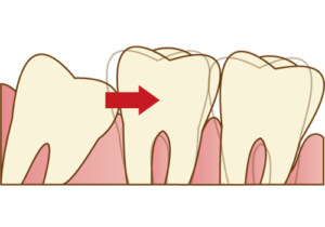 代々木駅前の矯正歯科、代々木クリスタル歯科医院で親知らずがある場合の矯正治療