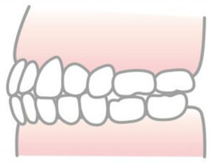 代々木駅前の矯正歯科、代々木クリスタル歯科医院の切端咬合について解説
