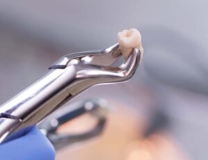 代々木駅前の矯正歯科、代々木クリスタル歯科医院で矯正治療で前歯のすき間をなくしたいときの方法についての解説