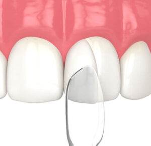 代々木駅前の矯正歯科、代々木クリスタル歯科医院で矯正治療で前歯のすき間をなくしたいときの方法についての解説