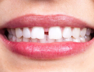 代々木駅前の矯正歯科、代々木クリスタル歯科医院で矯正治療で前歯のすき間をなくしたいときの方法についての解説