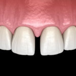 代々木駅前の矯正歯科、代々木クリスタル歯科医院で矯正治療で前歯のすき間をなくしたいときの方法についての解説