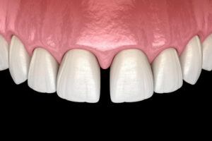 代々木駅前の矯正歯科、代々木クリスタル歯科医院で矯正治療で前歯のすき間をなくしたいときの方法についての解説