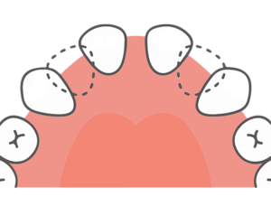 代々木駅前の矯正歯科、代々木クリスタル歯科医院で矯正治療で前歯のすき間をなくしたいときの方法についての解説