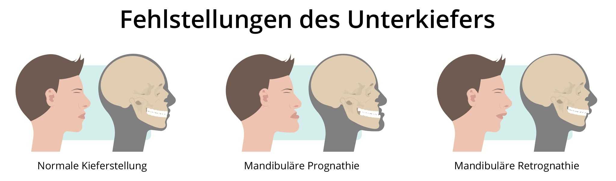 代々木駅前の矯正歯科、代々木クリスタル歯科医院で矯正治療で顎変形症についての解説