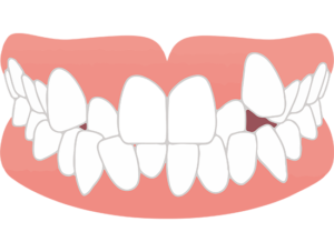 代々木駅前の矯正歯科、代々木クリスタル歯科医院で部分矯正が「よくない」といわれるのはなぜ？リスクやデメリットを解説