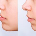 代々木駅前の矯正歯科、代々木クリスタル歯科医院で受け口（反対咬合）が引き起こす健康への影響を解説